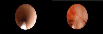 Olbert’s Balloon Dilatation as a Minimally Invasive Possibility of Treating Ureteral Stricture After Complicated URS-L in Children